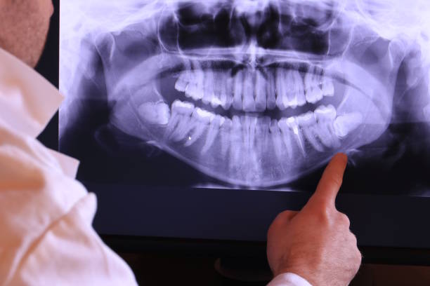 Best Emergency Wisdom Tooth Extraction in Mount Vernon, OH