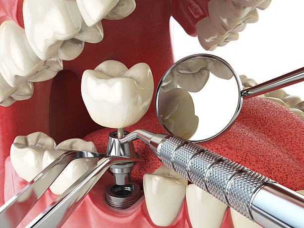 Best Emergency Cosmetic Dentistry (e.g., broken veneers) in Mount Vernon, OH